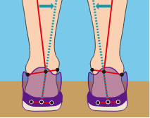 LOWアーチの足首